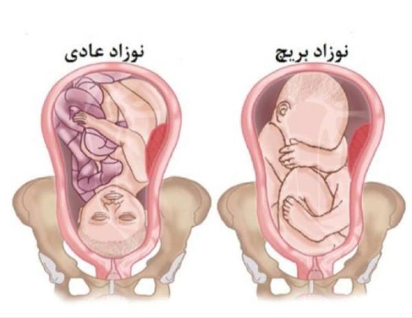 هر آنچه که باید درباره جنین بریچ بدانید