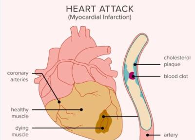 اسکن های تازه قلبی می توانند سال ها قبل از وقوع حملات قلبی به بیماران هشدار دهند